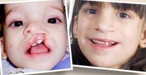 cleft-lip-3d-printing-shriners